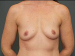 BREAST AUGMENTATION: Case 89 Before