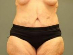 ABDOMINOPLASTY FOLLOWING SIGNIFICANT WEIGHT LOSS : Case 79 After