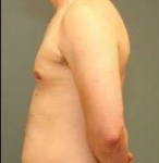 MALE CHEST CONTOURING / GYNECOMASTIA: Case 51 After