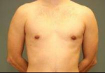 MALE CHEST CONTOURING / GYNECOMASTIA: Case 55 After