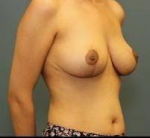 BREAST LIFT: Case 42 After